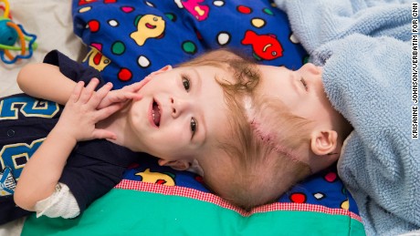 Blythedale Children’s Hospital: The amazing journey of the formerly conjoined twins